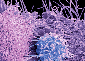 Prostate cancer cell, coloured scanning electron micrograph (SEM). of the surface of prostate cancer cells. The cells shows numerous processes and microvilli (fine surface projections). These features are characteristic of highly mobile cells, and enable cancerous cells to spread (metastasis) rapidly round the body, and invade other organs and tissues. Cancer cells divide rapidly and chaotically, and may clump to form malignant tumours. The prostate is a small gland found in men just below the bladder, surrounding the urethra, the tube urine passes through. Prostate cancer is most prevalent in men over 50 years of age. Treatment is with hormone therapy, chemotherapy, or surgical removal of the prostate. Magnification: x 8000 when printed at 10 centimetres across.