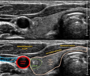 Ultrasound image of thyroid