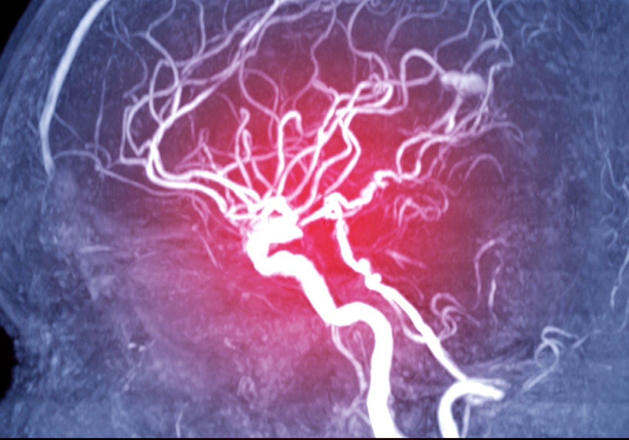 Magnetic resonance image (MRI) of Vessel in the brain sagittal view or MRA brain.