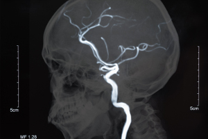 neurosurgery via blood vessels
