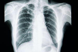 x-ray of lung