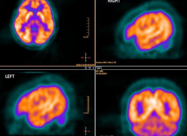 These are computer generated images called PET (positron emission tomography) of the brain. It consists of injecting a radioactive analogue of glucose, FDG (fluorodeoxyglucose) into the bloodstream; the three- dimensional images of tracer concentration within the brain are then constructed by computer computer analysis. The more metabolically active areas will retain more FDG, and consequently retain more radioation (brighter areas). It is an important tool for detecting malignant tumors such as metastasis mainly in other parts of the body. In the brain, it also has been used to detect areas of the brain that generate seizures.