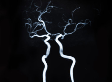 Blood vessels in the brain