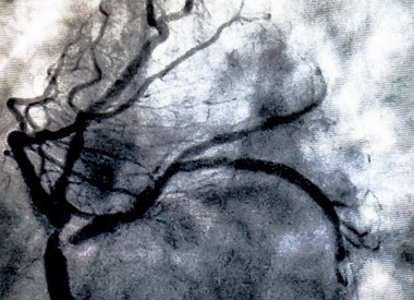 Catheterization. Cardiac ventriculography is a medical imaging test used to determine a patient cardiac function in the right or left ventricle