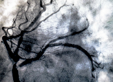 stroke in brain