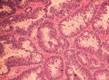 Microscopic image of colonic adenocarcinoma with Hematoxylin and eosin stain (H&E stain)
