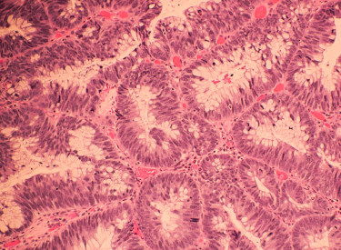 cross section of colon cancer