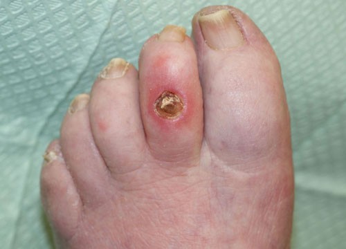 Case 3 - Foot Ulcer
