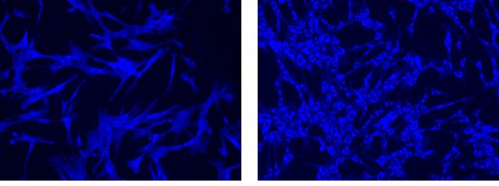 Filipin staining of cultured skin fibroblasts 