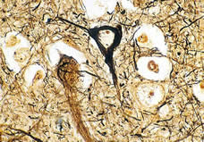 Neuropathology