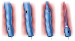  Schematic of endovenous laser treatment  (Photo courtesy of Diomed, Inc.)  