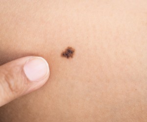 A suspicious mole or melanoma